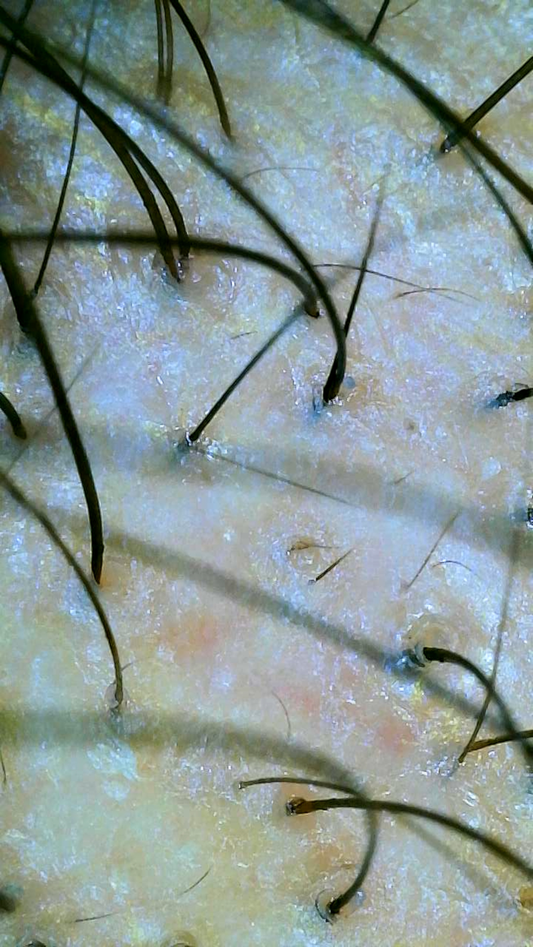 tricoscopia